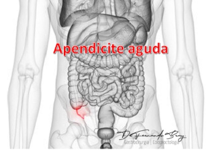 APENDICITE: O que é e Como Tratar?