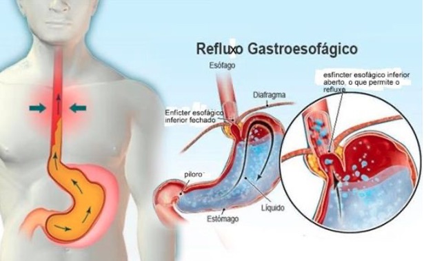 Cirurgia de refluxo: tudo o que você precisa saber