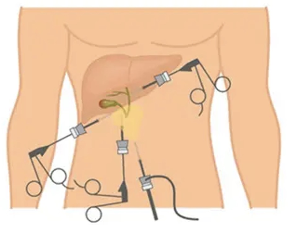 Colecistectomia: quando a cirurgia é necessária?