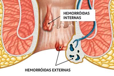 Como tratar a trombose das hemorróidas: do alívio imediato à cirurgia