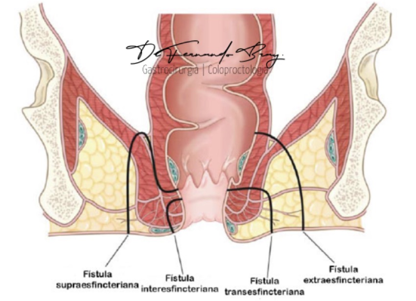Diagnóstico da fístula anal