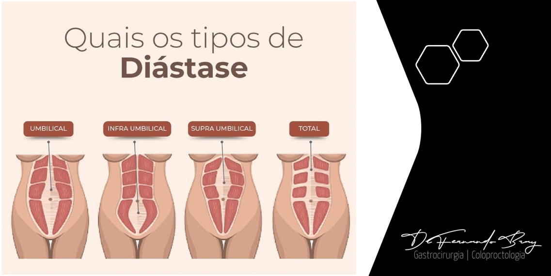 Diástase Abdominal: Como funciona a Correção de Diástase por Cirurgia Robótica?