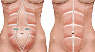 Diástase abdominal não ocorre apenas no pós-parto