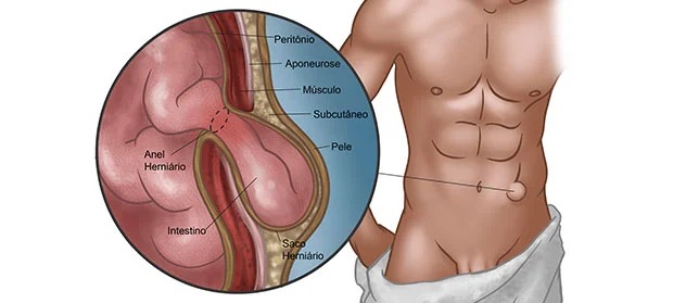 Dor após cirurgia de hérnia inguinal: quando ela se torna crônica e o que fazer?