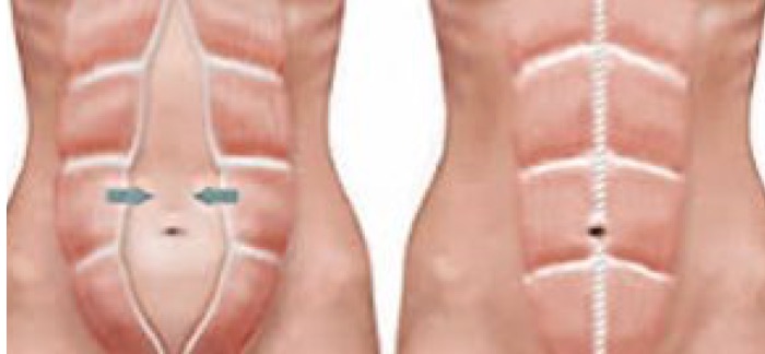 Dor retal pode ser endometriose?