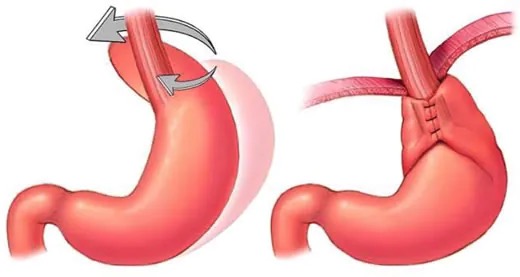 Entenda como é a cirurgia do refluxo gastroesofágico