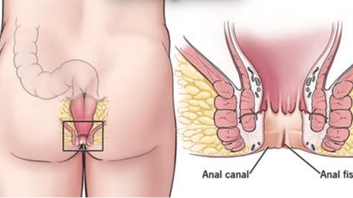 Fissura Anal: tratamento com Botox