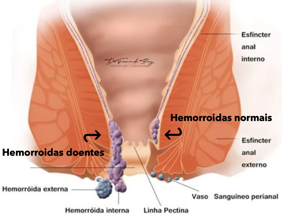 Hemorroida pode virar câncer?