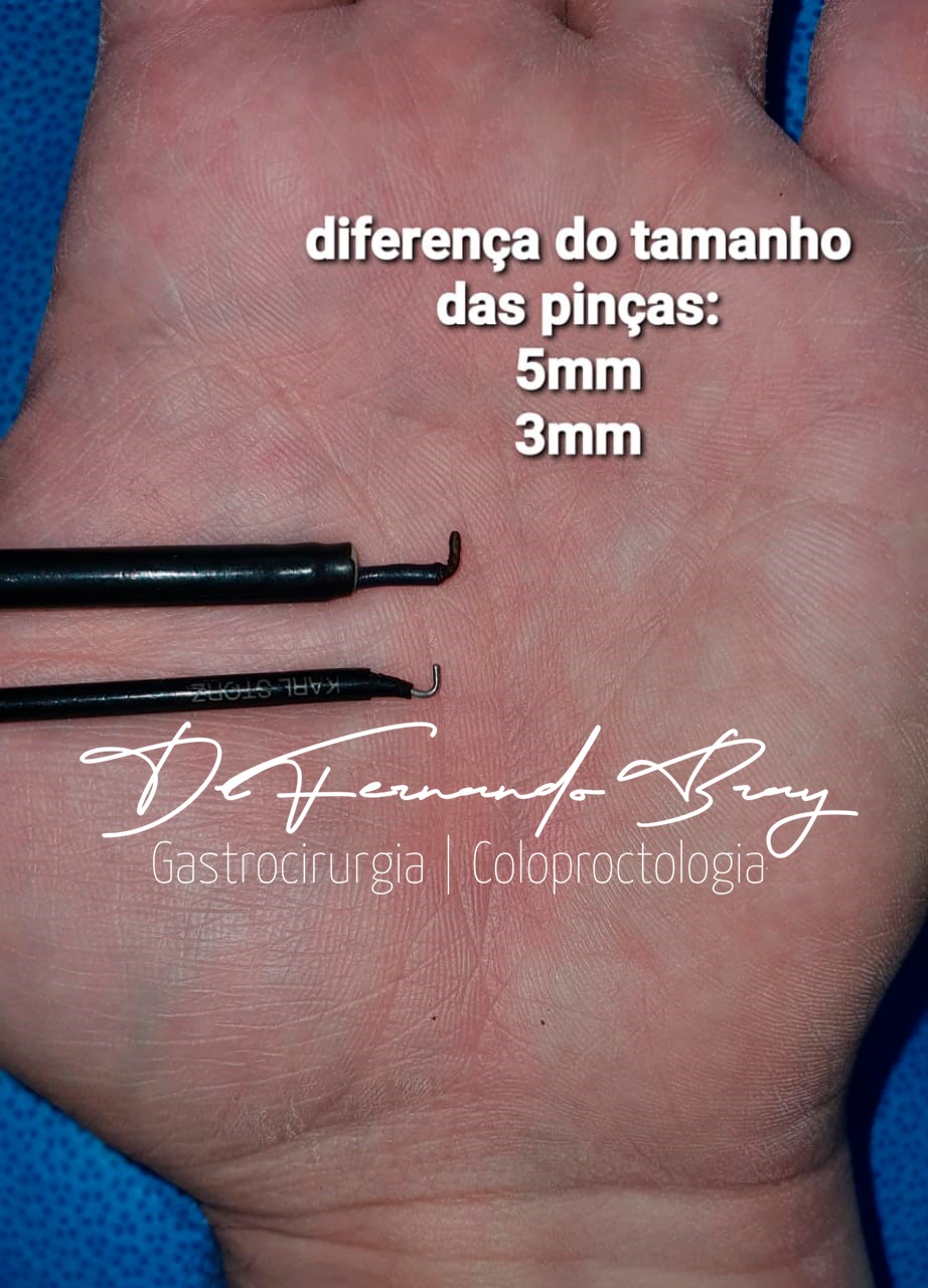 Minilaparoscopia: características e vantagens da técnica cirúrgica