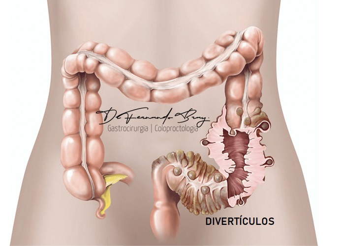 O que é Diverticulite?