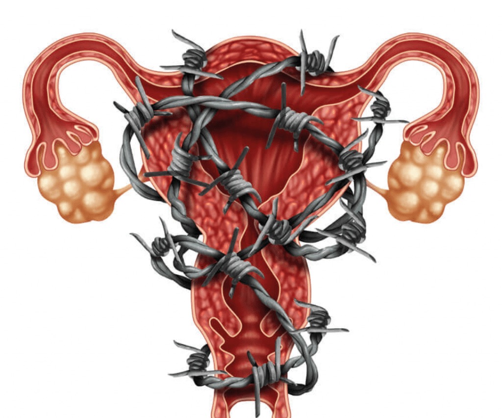 O que é endometriose e quais os sintomas?