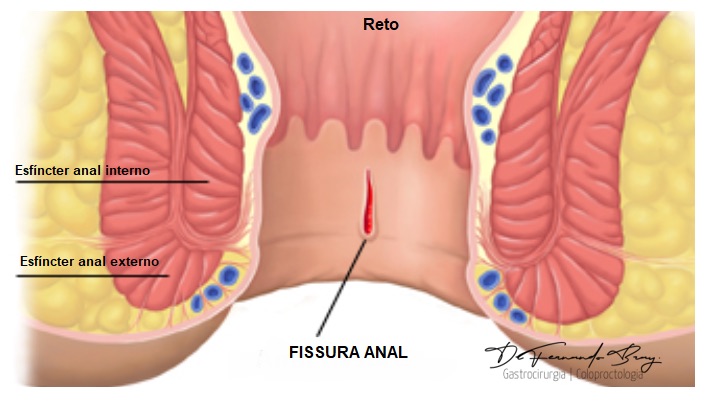O que é Fissura Anal? Sintomas e tratamentos