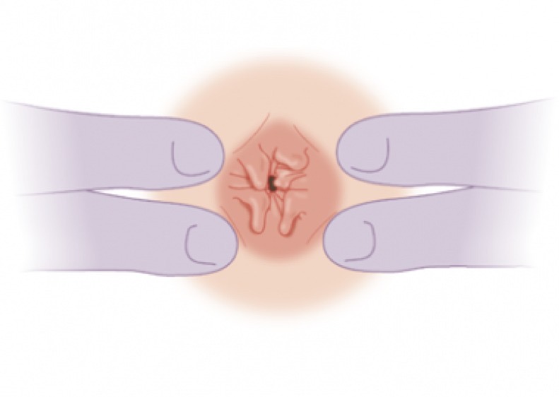 Por que os plicomas anais podem voltar depois da cirurgia?