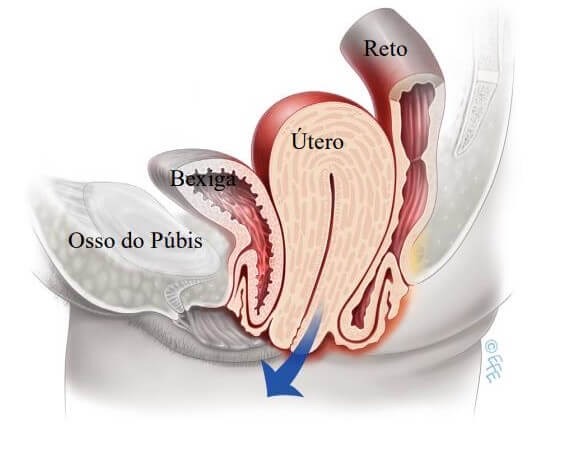 Prolapso dos órgãos pélvicos