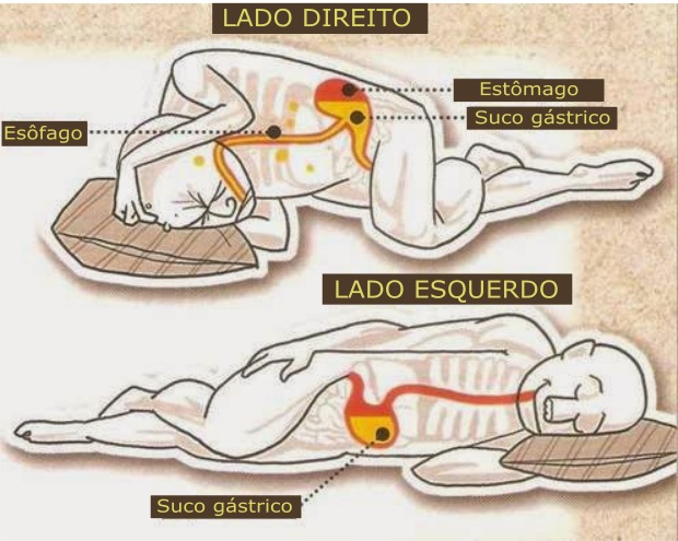 Refluxo gastroesofágico: Perguntas frequentes e respostas