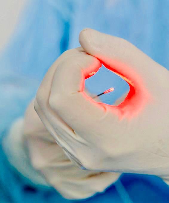 TRATAMENTO DE FÍSTULA ANAL COM LASER: Tudo o que você precisa saber