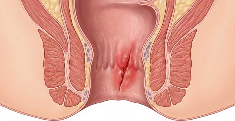 Uso de toxina botulínica na fissura anal: quando o botox é a melhor opção