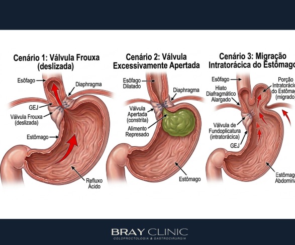 Você fez cirurgia de refluxo e não está bem? Entenda a reoperação