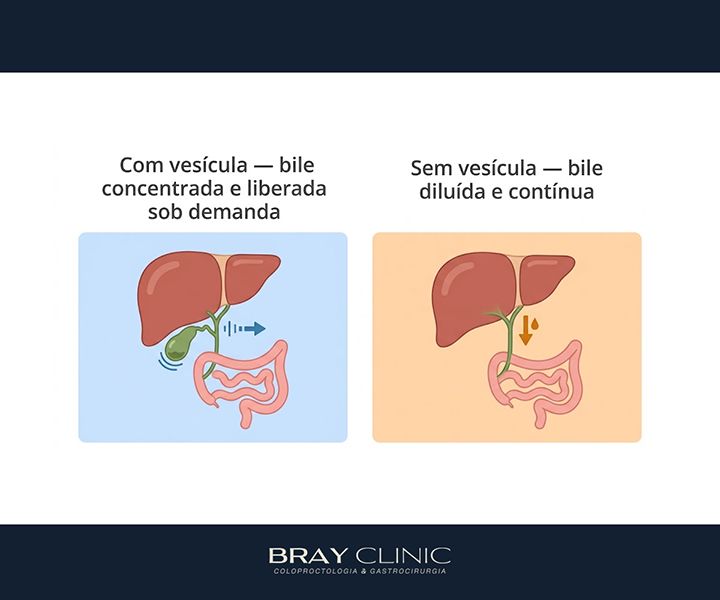 Suplementação pós retirada da vesícula: quais nutrientes merecem atenção