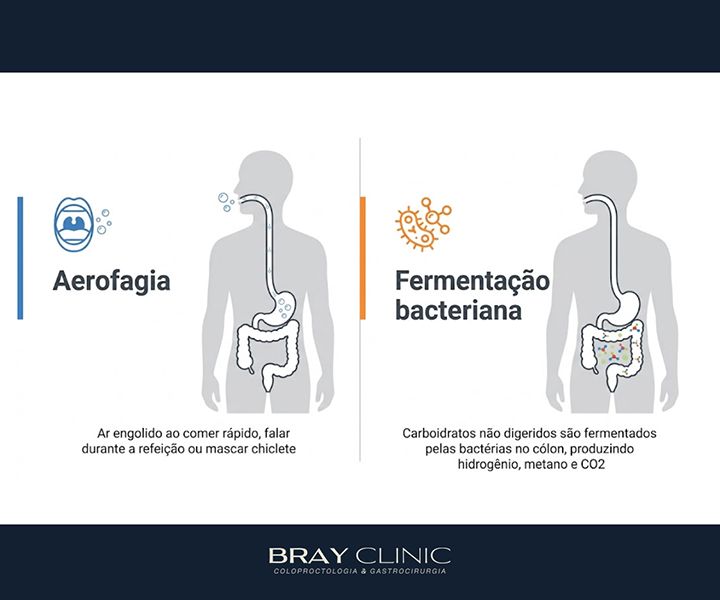 Gases intestinais: por que acontecem e o que fazer para aliviar