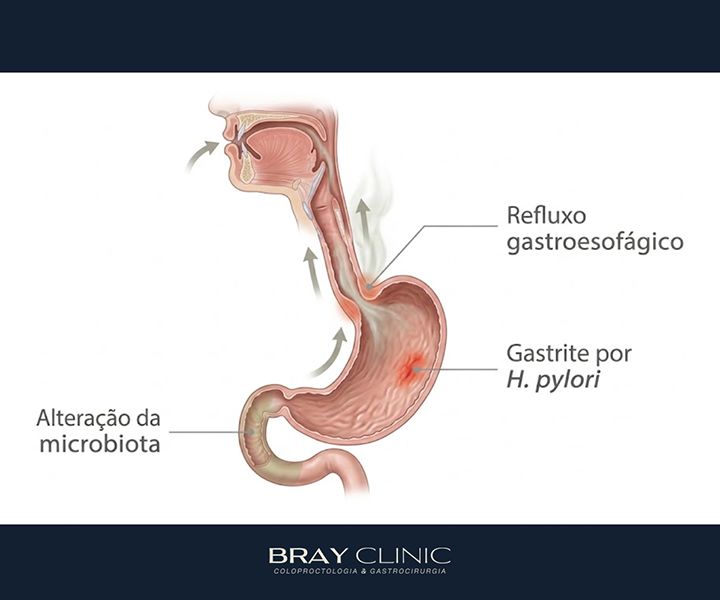 O que causa o hálito ruim e quando ele indica um problema digestivo