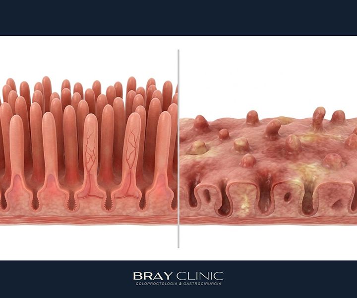 Doença celíaca: entenda a condição autoimune e saiba como recuperar a saúde intestinal