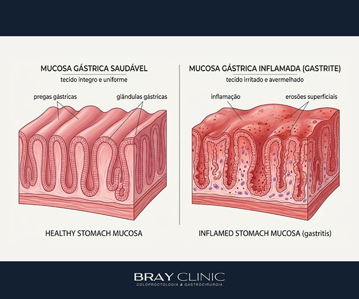 Gastrite: entenda a inflamação no estômago e saiba como cuidar da sua saúde
