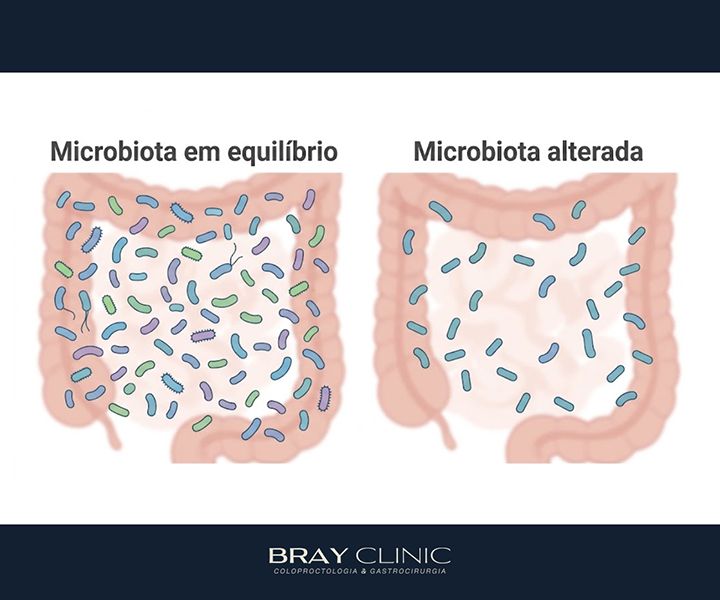 Suplementação pós retirada da vesícula: quais nutrientes merecem atenção