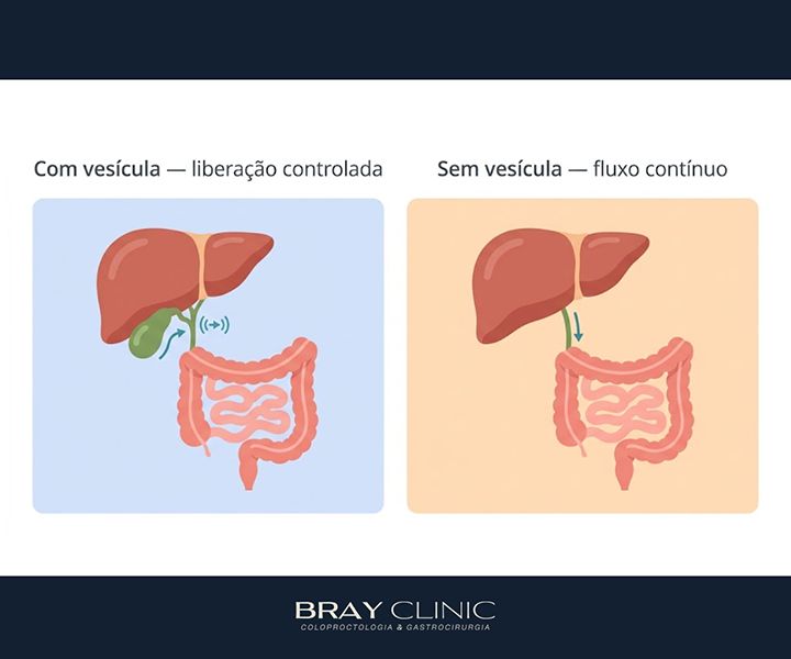 Sais biliares: entenda sua função na digestão e quando podem causar problemas