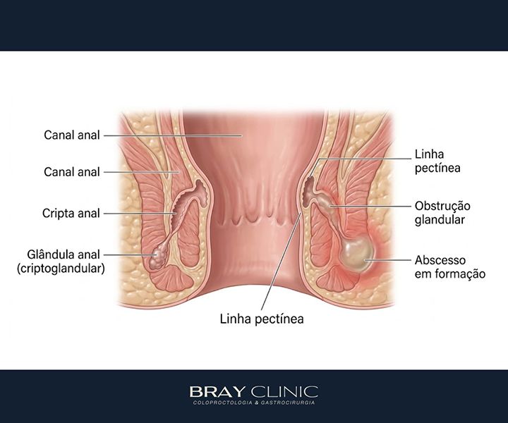 Abscesso perianal: como reconhecer os sintomas e agir a tempo