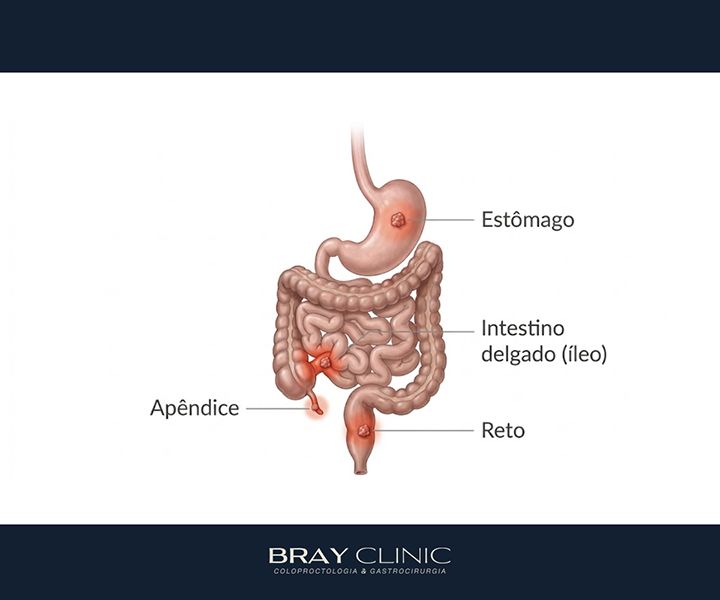 Tumor carcinoide: entenda o que é esse tipo de tumor neuroendócrino