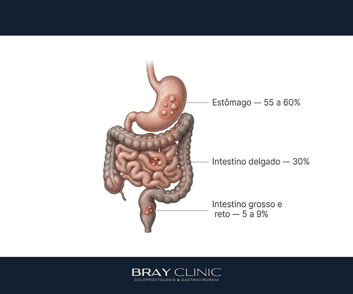 O que é GIST e como esse tumor é diagnosticado e tratado