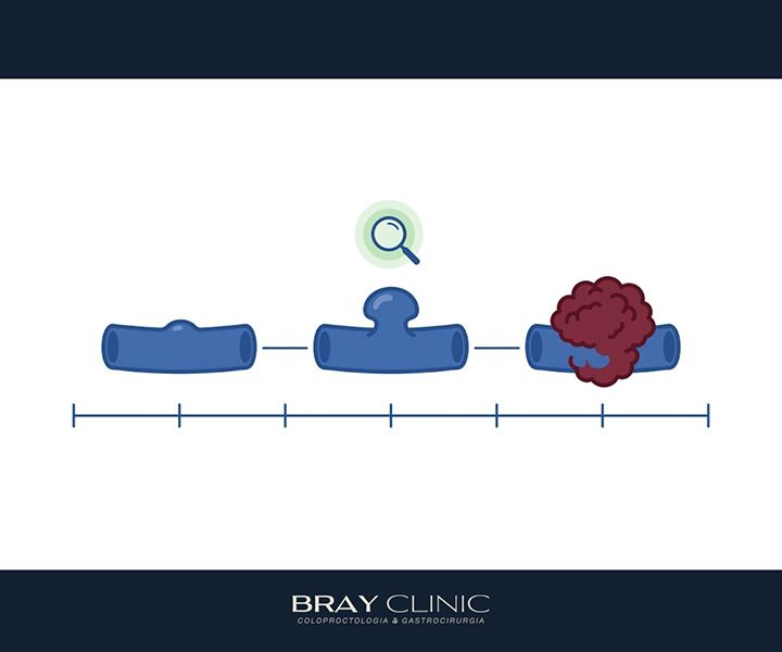 Sinais e sintomas de câncer de intestino: como identificar e por que agir cedo