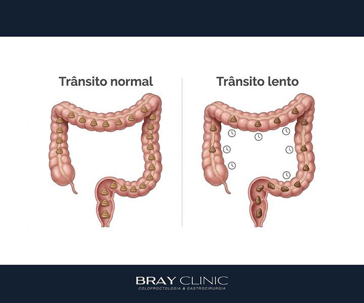Tipos de constipação intestinal e como cuidar de cada um