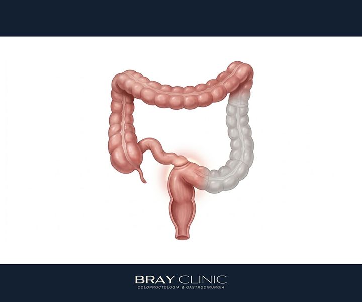Como tratar a inércia colônica e devolver o movimento ao intestino