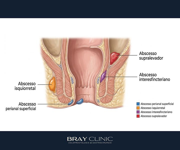 Abscesso perianal: como reconhecer os sintomas e agir a tempo
