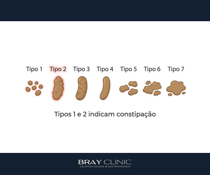Tipos de constipação intestinal e como cuidar de cada um