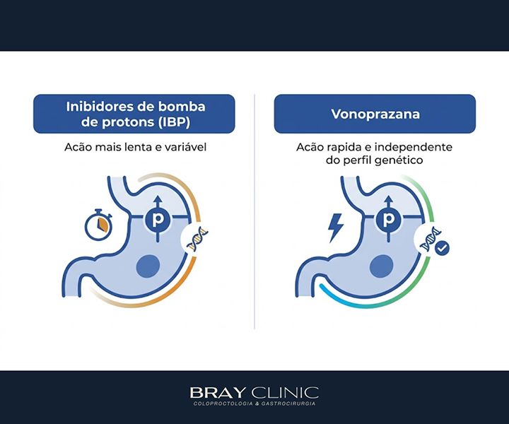 H. pylori: o que mudou no tratamento e como erradicar a bactéria