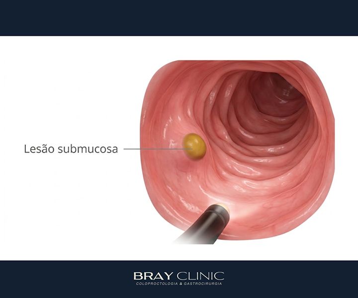 Tumor carcinoide: entenda o que é esse tipo de tumor neuroendócrino