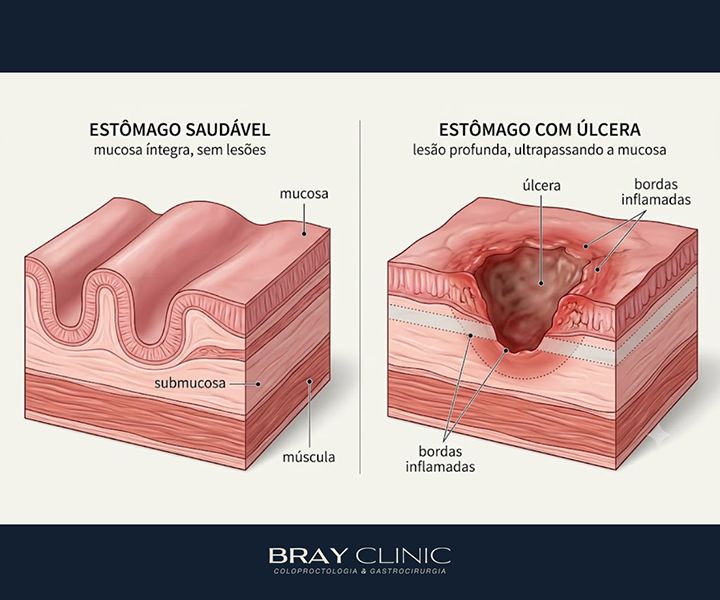 Úlcera gástrica: entenda as causas, os riscos e o caminho para o tratamento