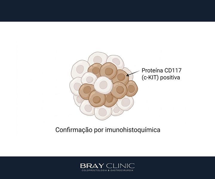 O que é GIST e como esse tumor é diagnosticado e tratado