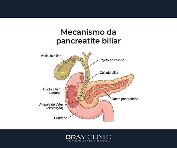 Pancreatite: entenda a inflamação no pâncreas e saiba como cuidar da sua saúde